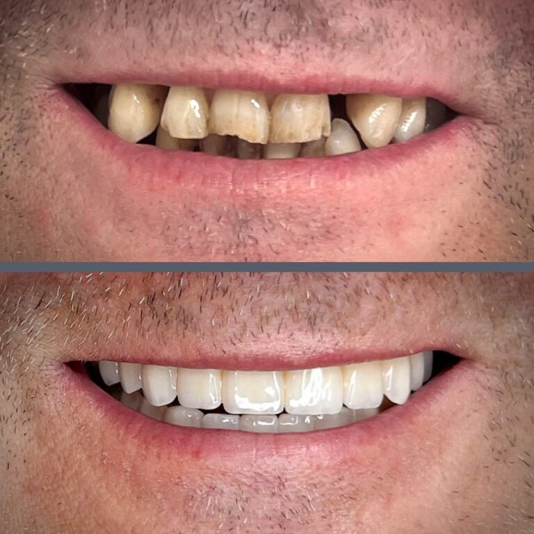 All-on-4 before-after